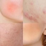 کرم ترمیم‌کننده پیشرفته آپومدرم | Apomederm Breath Dressing Cream - Image 8
